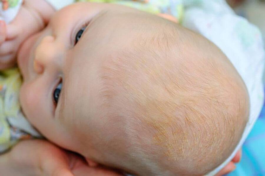 Не только диатез: почему у ребенка сухая кожа?