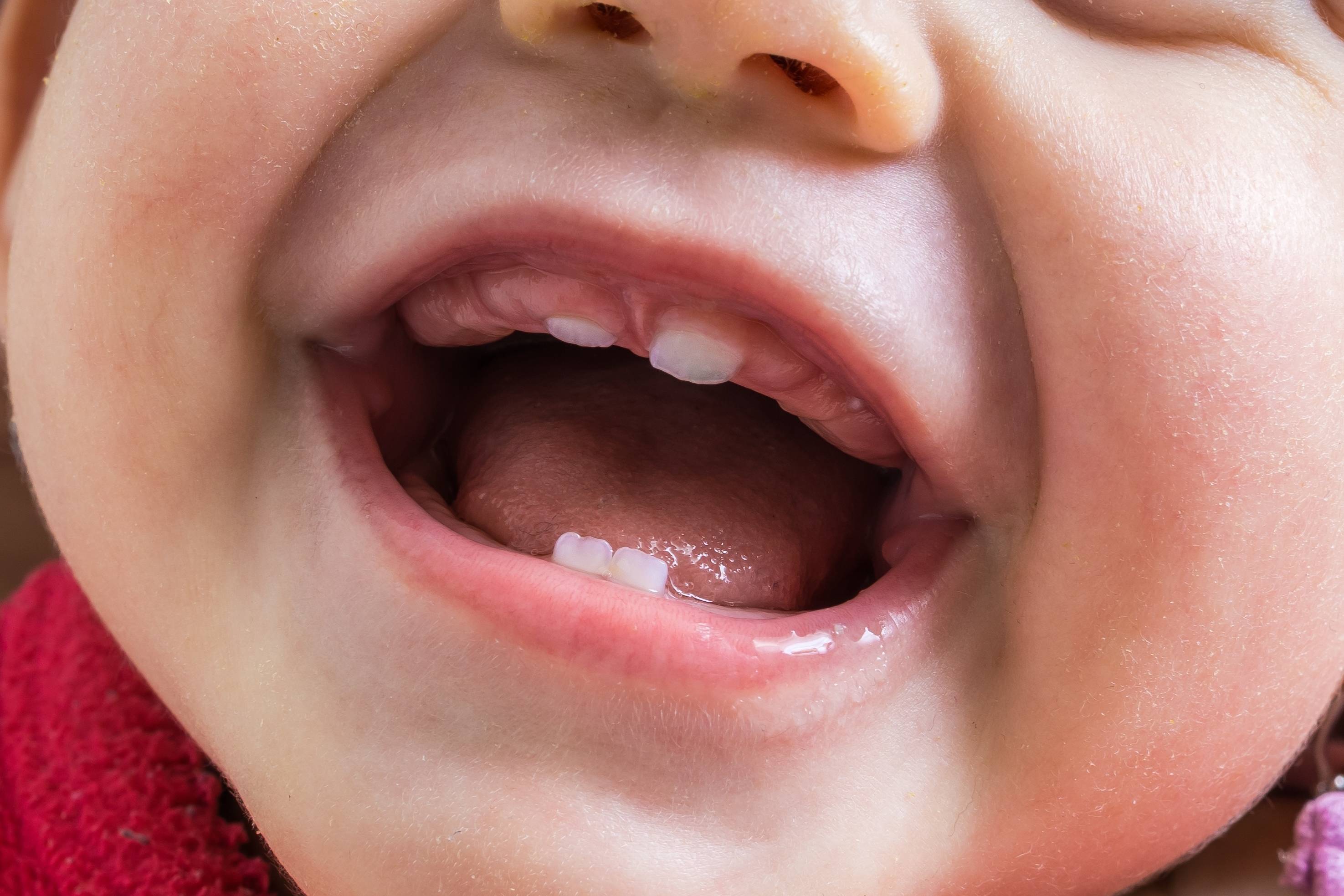 5 способов как обезболить зуб мудрости в домашних условиях