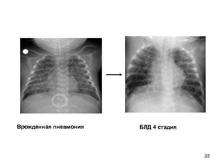 Врожденный туберкулез. Пневмония у новорожденного рентген. Бронхолегочная дисплазия у новорожденных рентген. Бронхолёгочная дисплазия у новорождённых 4 стадия рентген.