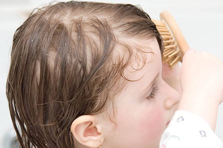 Выпадение волос прядями. что делать при выпадении волос пучками