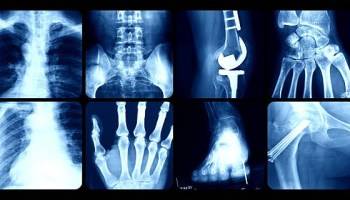 Чем отличается флюорография от рентгенографии легких