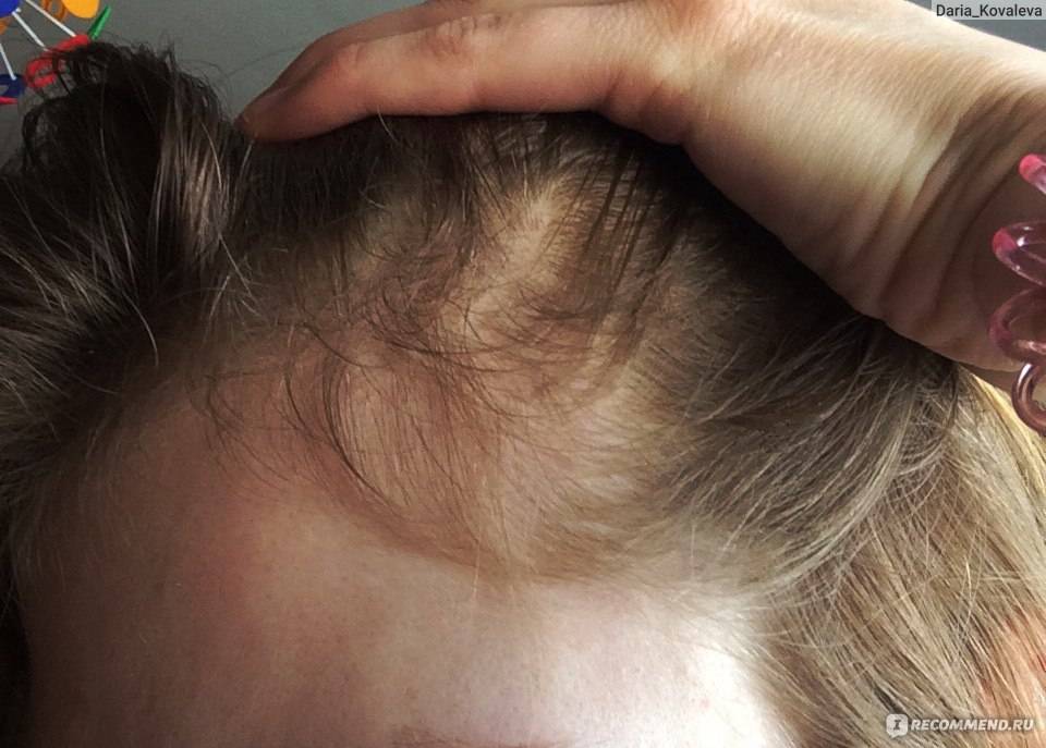 Выпадают волосы у ребенка 3 лет что делать комаровский