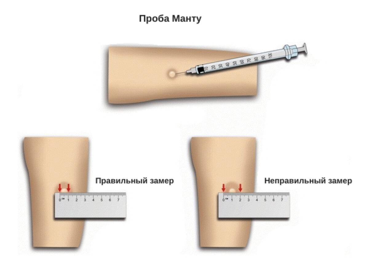 Диаскинтест можно ли. Туберкулиновая проба реакция манту. Папула 4 мм реакция манту. Реакция манту папула 5 мм. Проба манту норма у детей.