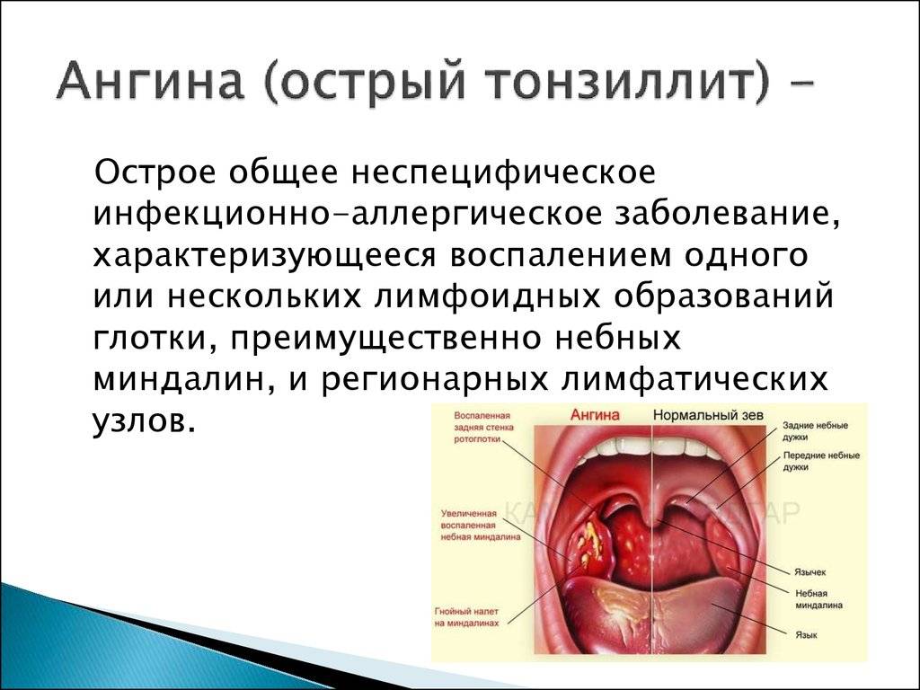 Молочница во рту (кандидоз полости рта) + фото
