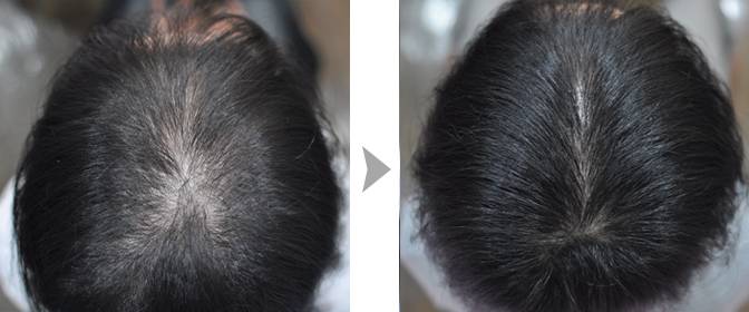 Выпадение волос после родов, как убрать залысины и причины их появления