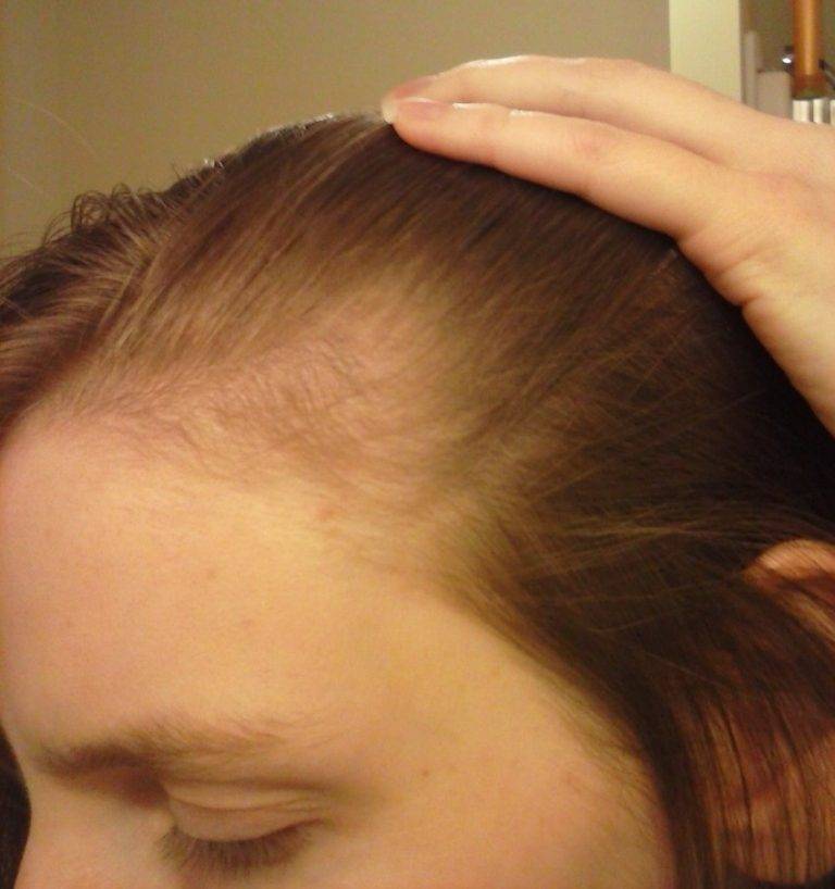 Как остановить выпадение волос после родов?