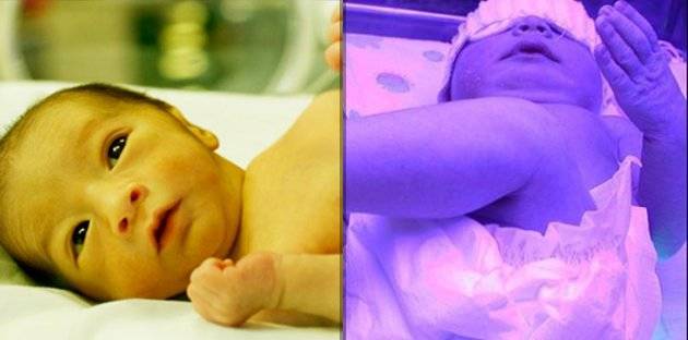 Желтуха у новорожденных: возможны ли серьезные последствия?