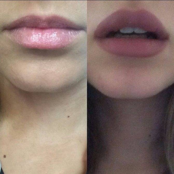 Увеличение губ гиалуроновой кислотой – фото до и после, отзывы