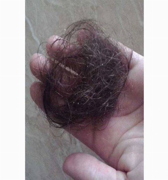 Выпадение волос (алопеция)