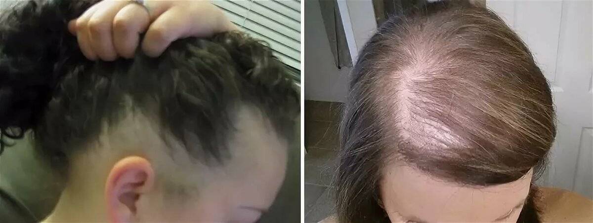Причины выпадения волос у женщин | компетентно о здоровье на ilive