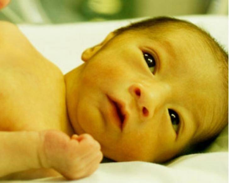 Как лечится желтуха у новорожденных в родильном доме?