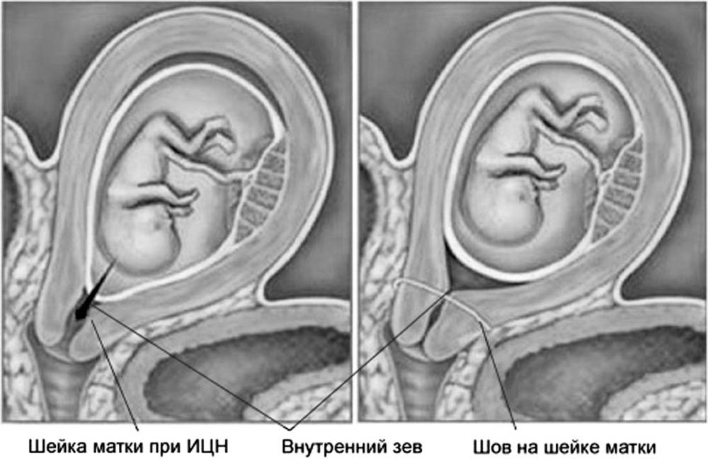 Швы после родов: процесс заживления, уход до снятия, какие бывают осложнения