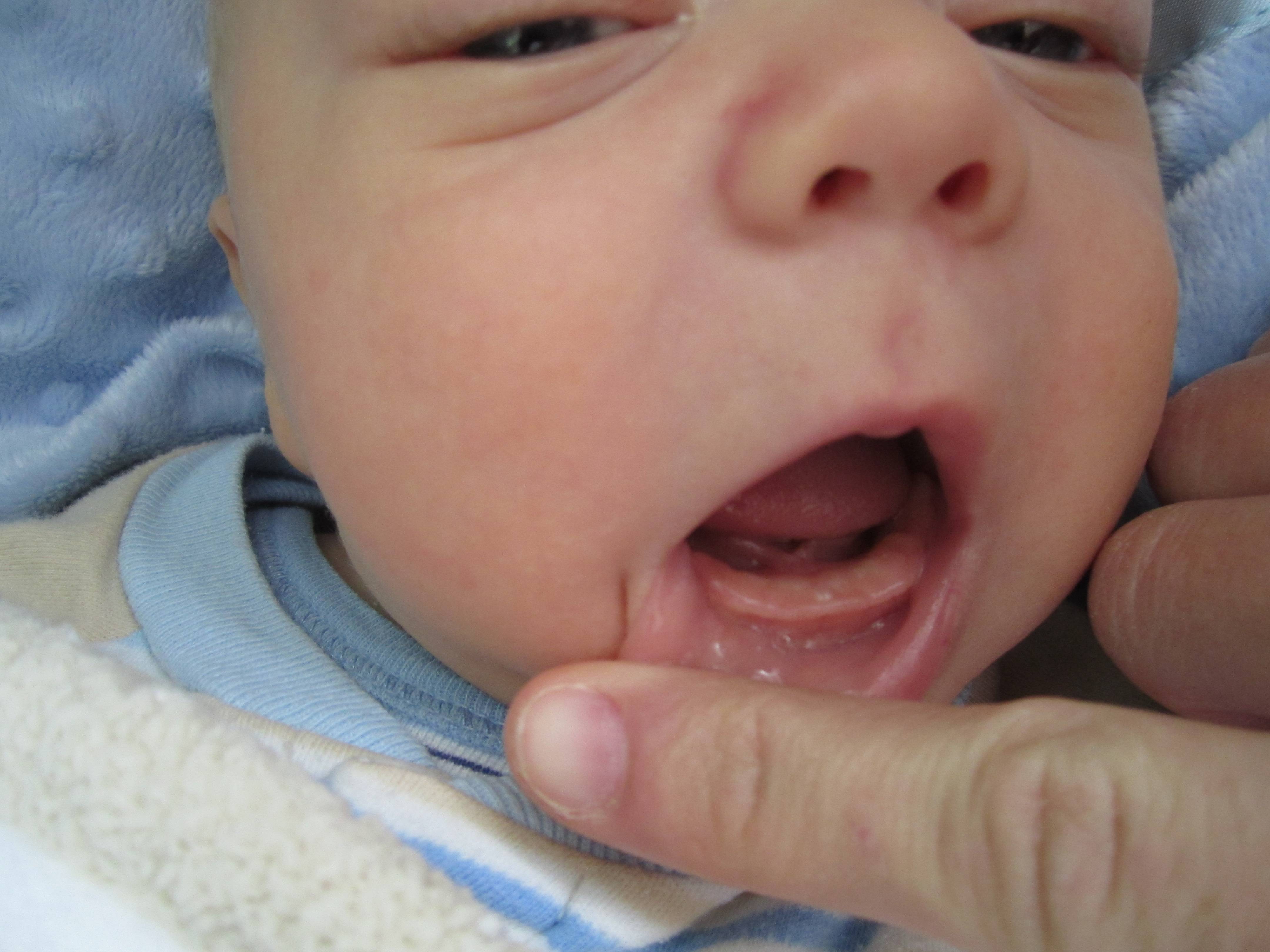 Понос при прорезывании зубов у детей: сколько дней держится жидкий стул, что советует комаровский?