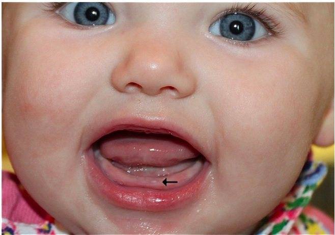Понос при прорезывании зубов у детей: сколько дней держится жидкий стул, что советует комаровский?