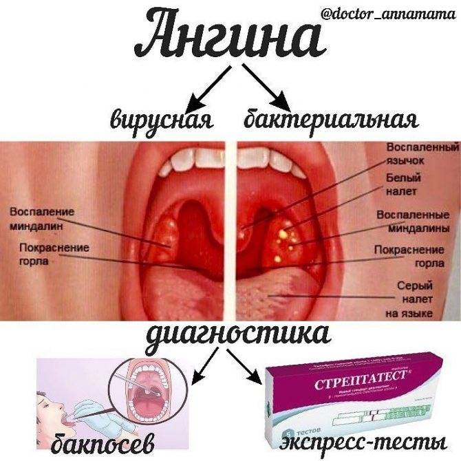 Ангина у взрослых: катаральная, лакунарная, фолликулярная, герпетическая, флегмонозная симптомы и лечение