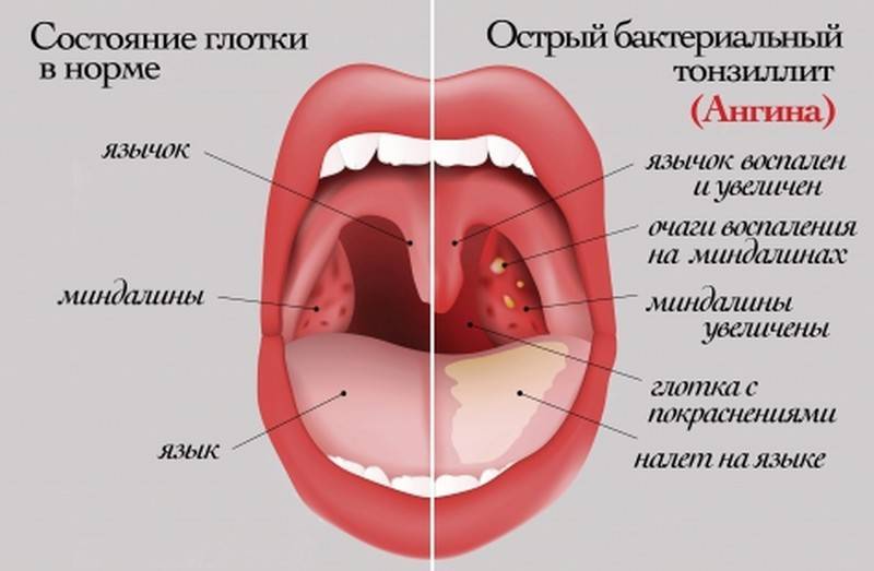 Молочница во рту (кандидоз полости рта) + фото