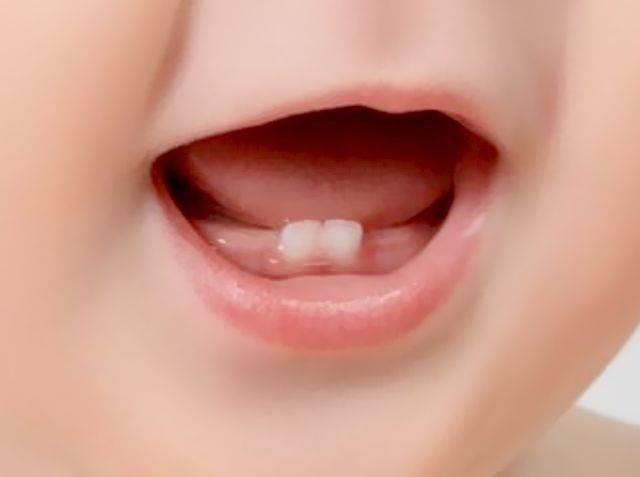 5 способов как обезболить зуб мудрости дома