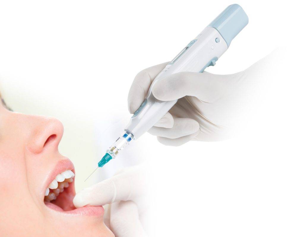 Что лучше - седация или местная анестезия при лечении зубов? - мнение специалиста