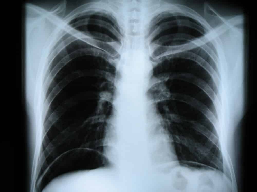 Можно ли делать рентген при грудном кормлении